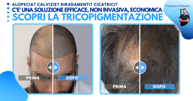 Perdita di capelli? Francesco D’Amario: “Tricopigmentazione nuova soluzione”